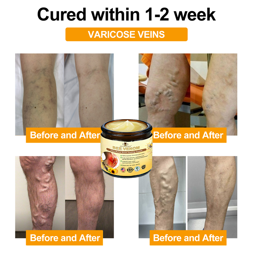 𝐀𝐫𝐭𝐡𝐫𝐨𝐅𝐫𝐞𝐞™ 𝐁𝐞𝐞 𝐕𝐞𝐧𝐨𝐦 𝐏𝐚𝐢𝐧 𝐑𝐞𝐥𝐢𝐞𝐟 𝐚𝐧𝐝 𝐁𝐨𝐧𝐞 𝐇𝐞𝐚𝐥𝐢𝐧𝐠 𝐂𝐫𝐞𝐚𝐦 (𝐄𝐬𝐩𝐞𝐜𝐢𝐚𝐥𝐥𝐲 𝐒𝐮𝐢𝐭𝐚𝐛𝐥𝐞 𝐟𝐨𝐫 𝐒𝐞𝐧𝐢𝐨𝐫𝐬, 𝐀𝐀𝐎𝐒 𝐑𝐞𝐜𝐨𝐦𝐦𝐞𝐧𝐝𝐞𝐝)